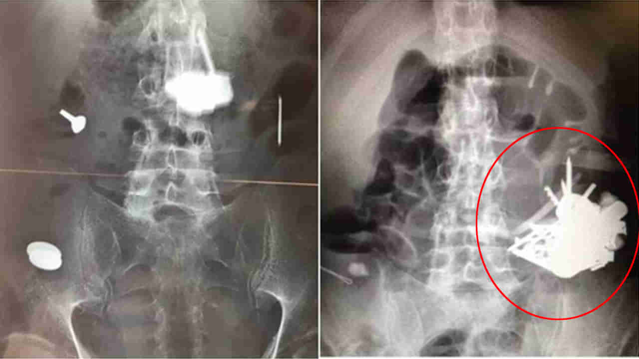 Viral: వ్యక్తికి ఆగకుండా రక్తపు వాంతులు, వికారం.. టెస్టులు చేయగా.. ‌ఎక్స్‌రేలో