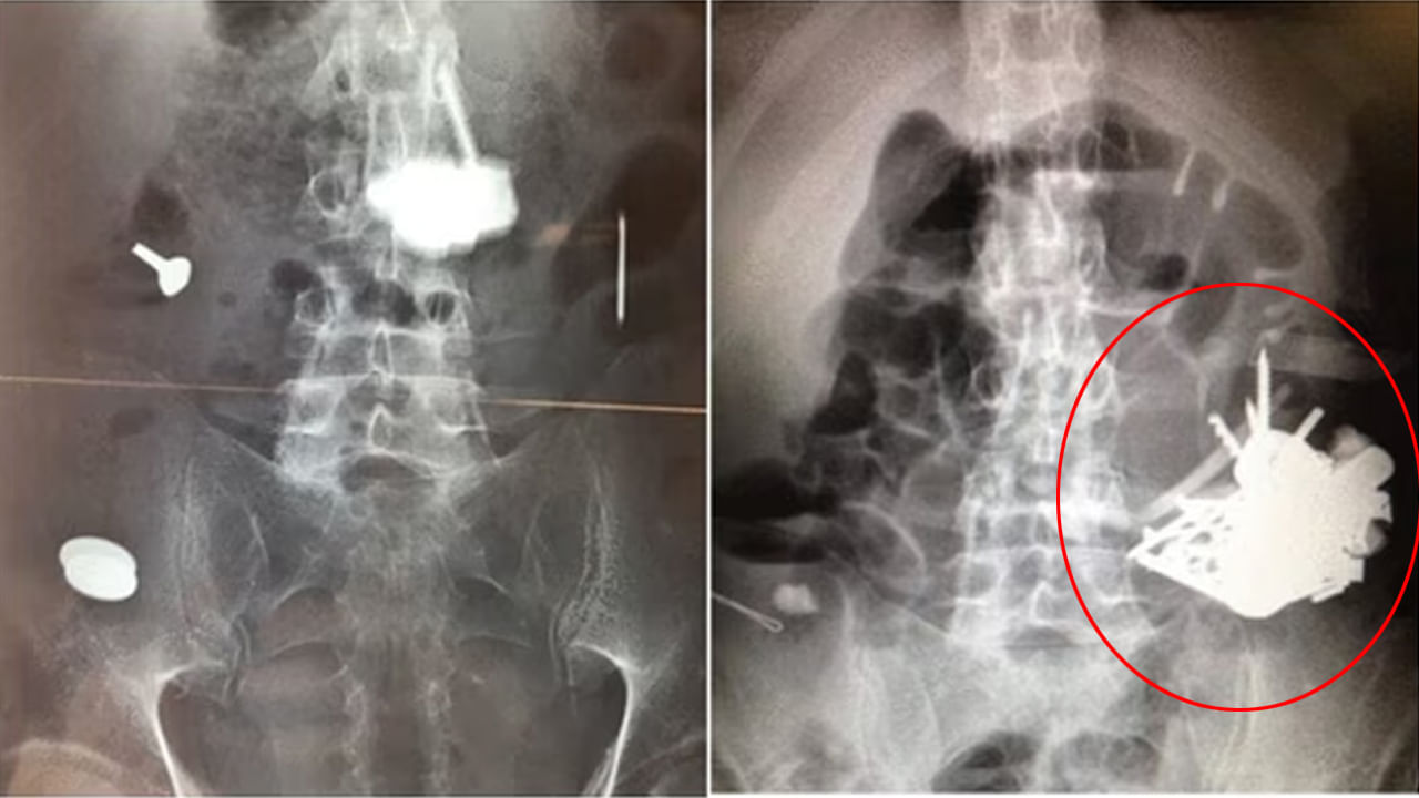 Viral: వ్యక్తికి ఆగకుండా రక్తపు వాంతులు, వికారం.. టెస్టులు చేయగా.. ఎక్స్రేలో