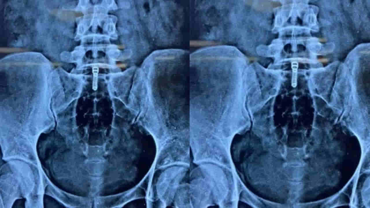 Viral: ఆ యువతికి 2 రోజులుగా మల విసర్జన అవ్వలే - పొత్తి కడుపులో నొప్పి - ఆస్పత్రికి వెళ్లగా