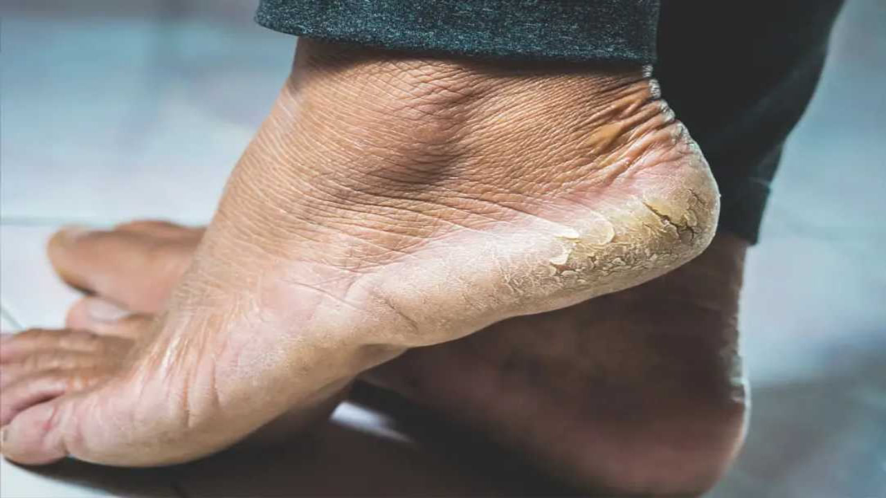 Cracked Heels: మడమలు పగిలాయా.. పటికతో ఇలా చేస్తే ఉపశమనం… Cracked Heels: మడమలు పగిలాయా.. పటికతో ఇలా చేస్తే ఉపశమనం…
