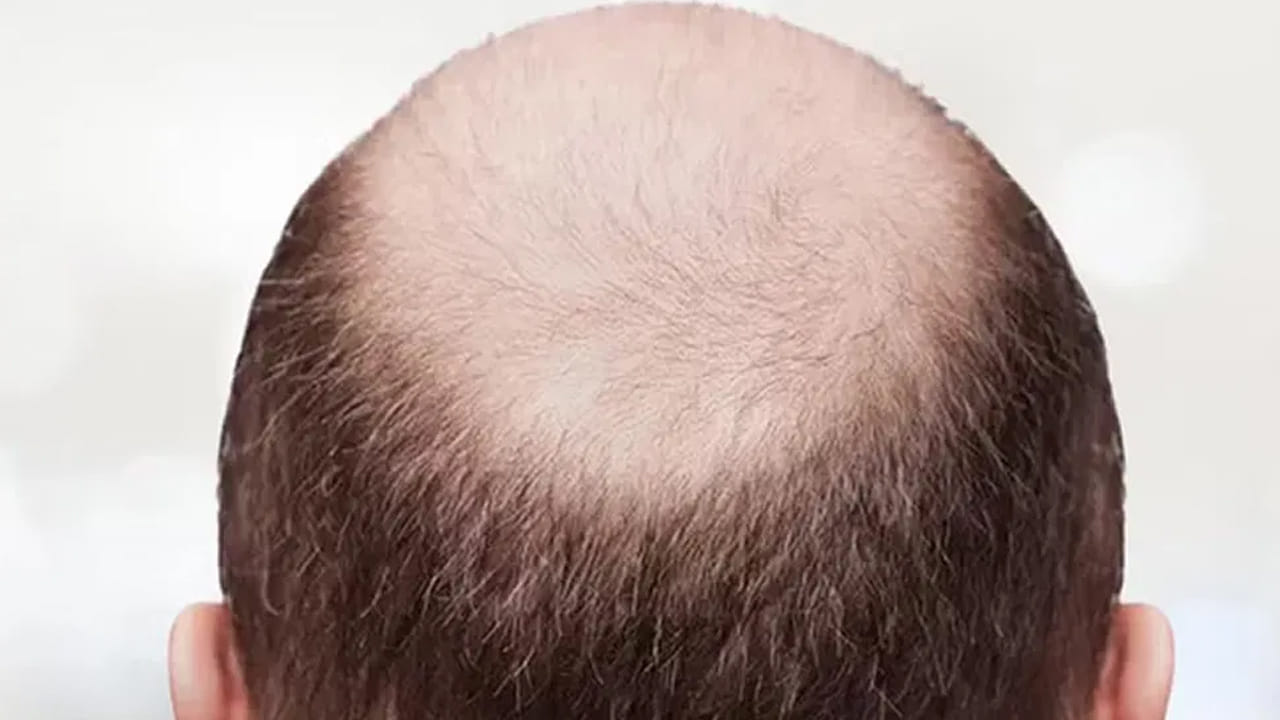 మారుతోన్న జీవన విధానం, తీసుకుంటోన్న ఆహారంలో మార్పులు, కాలుష్యం కారణంగా ఇటీవల బట్టతల సమస్య బారిన పడుతోన్న వారి సంఖ్య రోజురోజుకీ పెరిగిపోతోంది. ఒకప్పుడు 50 ఏళ్లు మళ్లిన వారిలోనే ఈ సమస్య కనిపించేది కానీ ఇప్పుడు పాతికేళ్లు కూడా నిండకుండానే బట్టతల సమస్యతో బాధపడుతున్నారు. నీటి కాలుష్యం, వాయు కాలుష్యం, హెల్మెట్లను ధరించడం వంటి వాటి వల్ల వెంట్రుకలు రాలిపోతున్నాయి. దీంతో రకరకాల ట్రీట్మెంట్లు తీసుకుంటున్నారు.