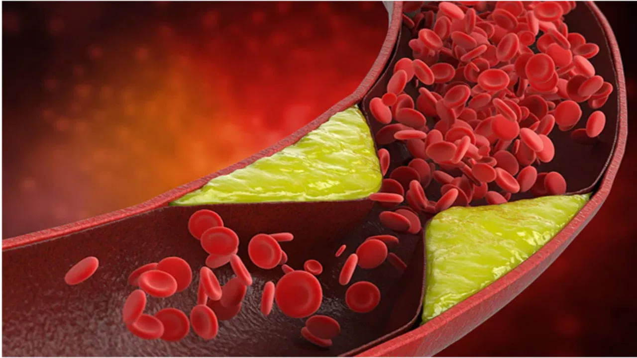 కొన్ని సార్లు అధిక కొలెస్ట్రాల్ గుండెపై ఒత్తిడిని పెంచుతుంది. దీనివల్ల నొప్పి భుజాలు, వీపు వరకు వ్యాపిస్తుంది. ఇలాంటి నొప్పి మీకు నిరంతరం ఉంటే తప్పకుండా వైద్యుడిని సంప్రదించాలంట. లేకపోతే ఇది స్ట్రోక్కు కారణం అవుతుందని చెబుతున్నారు ఆరోగ్య నిపుణులు.