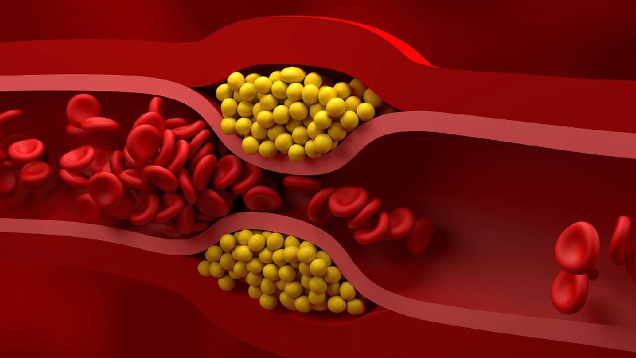 అయితే సమస్యను గుర్తించి చికిత్స చేయకపోతే ఇది గుండె జబ్బుల ప్రమాదాన్ని బాగా పెంచుతుందంట. వాస్తవానికి ఎఫ్ ఎచ్ ఉన్నవారి గుండె సమస్యలు వచ్చే ఛాన్స్ 20 రేట్లు ఎక్కువంట. 50 సంవత్సరాల వయసులో ఉన్న పురుషులు సగం మంది గుండెపోటుకు గురిఅవుతున్లు పరిశోధనలో తేలిందంట. అలాగే 60 సంవత్సరాలు ఉన్న మహిళలు 30 శాతం గుండెపోటు ప్రమాదాన్ని ఎదుర్కొంటున్నారంట. అందుకే ఈ విషయంలో చాలా జాగ్రత్తలు తీసుకోవాలని సూస్తున్నారు వైద్య నిపుణులు.