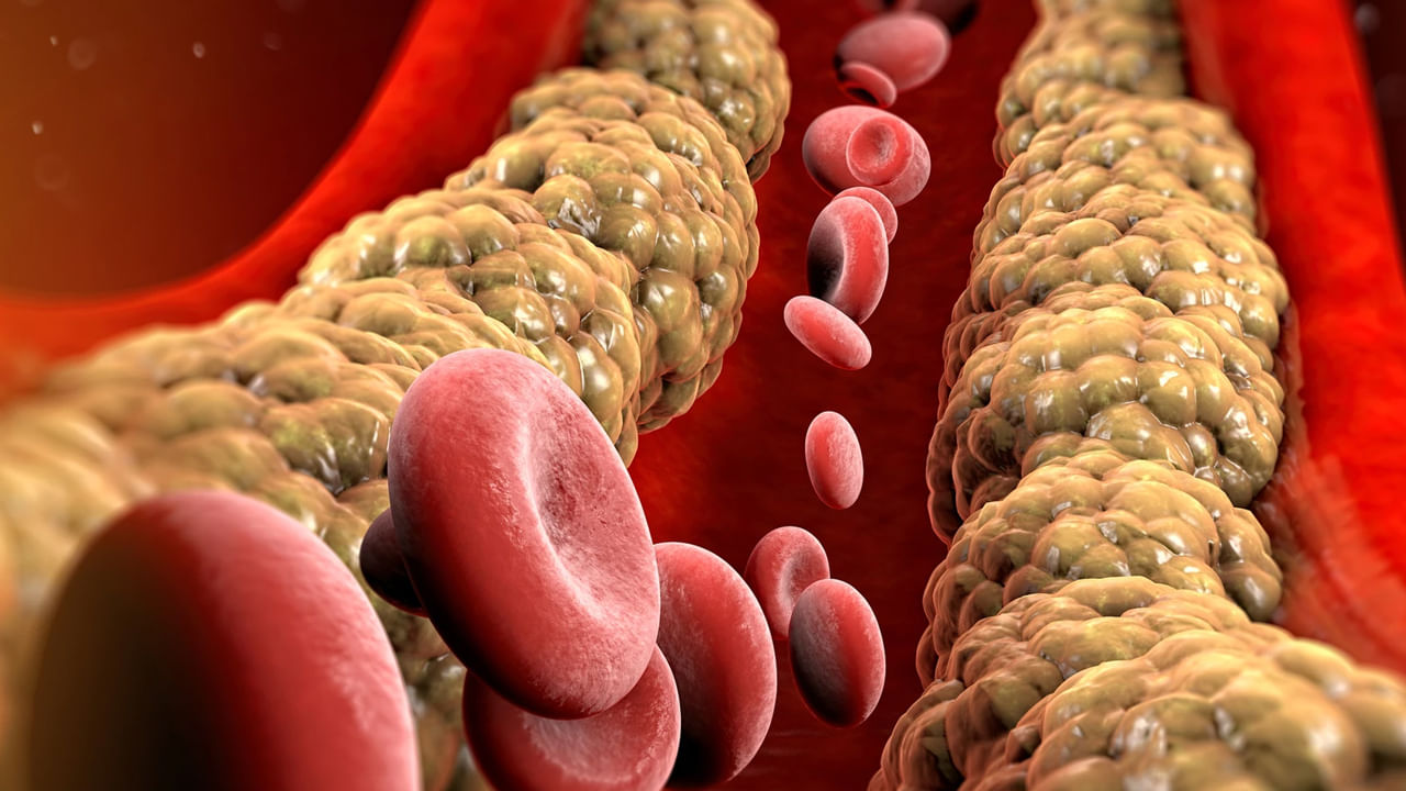 కొలెస్ట్రాల్ ఎక్కువ అవుతే శరీరంలో వివిధ రకాలైన నొప్పులు వస్తాయంట. అయితే ఎలాంటి పరిస్థితుల్లో మనం వైద్యుడిని సంప్రదించాలి? శరీరంలో కొలెస్ట్రాల్ ఎక్కువైతే ఎలాంటి సంకేతాలు కనిపిస్తాయో ఇప్పుడు మనం తెలుసుకుందాం. కొలెస్ట్రాల్ రెండు రకాలు, ఒకటి LDL ఇది చెడు కొలెస్ట్రాల్.HDL ఇది మంచి కొలెస్ట్రాల్.