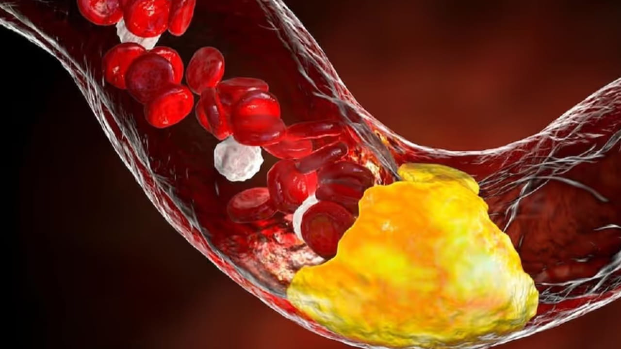 అధిక కొలెస్ట్రాల్ స్థాయిలు గుండె జబ్బుల ప్రమాదాన్ని పెంచుతాయి. మరీ ముఖ్యంగా ఫ్యామిలీ హైపర్ కొలెస్టెరోలేమియా ఉన్నవారిలో ఈ ప్రమాదం తీవ్రస్థాయిలో ఉంటుంది. అందు వలన జన్యపరమైన అధిక కొలెస్ట్రాల్ సమస్య ఉన్నవారు ప్రతి ఒక్కరూ 20 సంవత్సరాల వయసు నుంచి ప్రతి నాలుగు నుంచి ఆరు సంవత్సరాలకు ఒకసారి ఈ పరీక్షలు చేయించుకోవాలంట. ముఖ్యంగా కుటుంబ చరిత్ర ఉన్న వారు, గుండె జబ్బులు ఉన్న పిల్లలకు స్క్రీనింగ్ ముందుగానే ప్రారంభించాలంట.