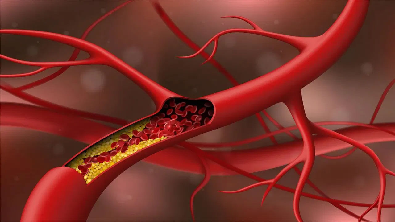 Cholesterol Risk