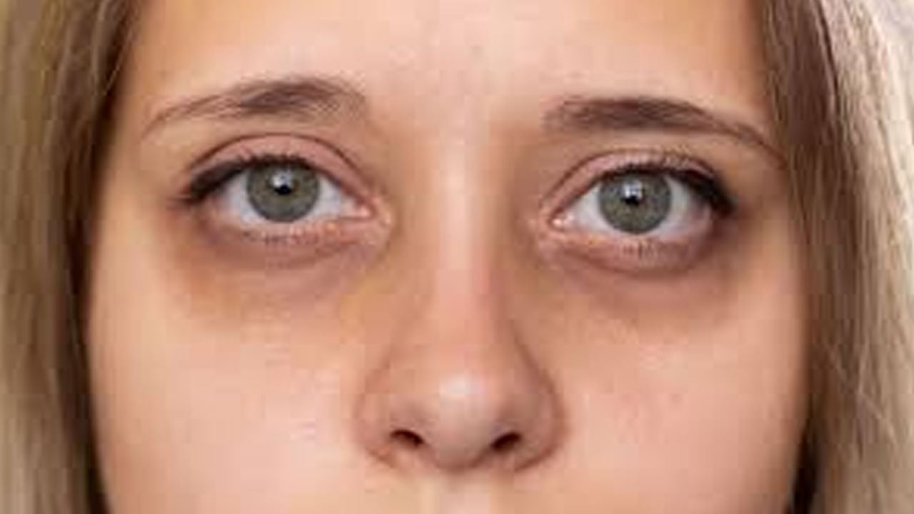 Dark Circles Under The Eyes: కళ్ళ కింద నల్లటి వలయాలతో ఇబ్బంది పడుతున్నారా..? ఇది తీవ్రమైన వ్యాధులకు సంకేతం కావొచ్చు..