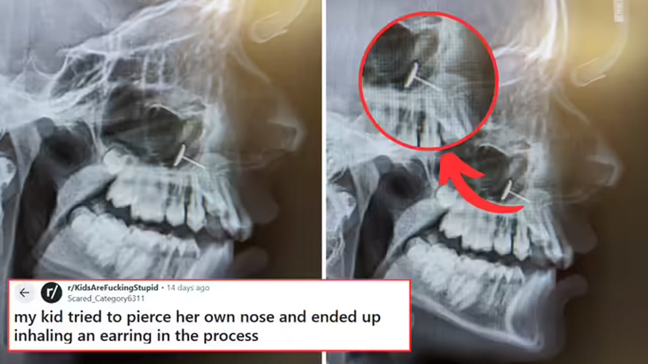 13ఏళ్ల కూతురి డెంటల్ ఎక్స్రే చూసి అంతా షాక్..! 6 నెలల క్రితం తల్లి మాట వినకుండా చేసిన పనితో...