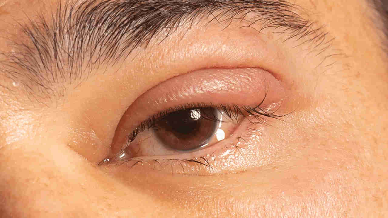 Health Tips: మీ కళ్ళలో ఈ లక్షణాలు కనిపిస్తున్నాయా.. ఒక్క క్షణం ఆలస్యం చేసినా, జీవితాంతం నరకమే..