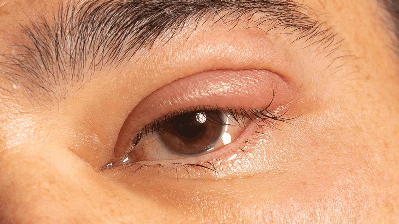 Health Tips: మీ కళ్ళలో ఈ లక్షణాలు కనిపిస్తున్నాయా.. ఒక్క క్షణం ఆలస్యం చేసినా, జీవితాంతం నరకమే..