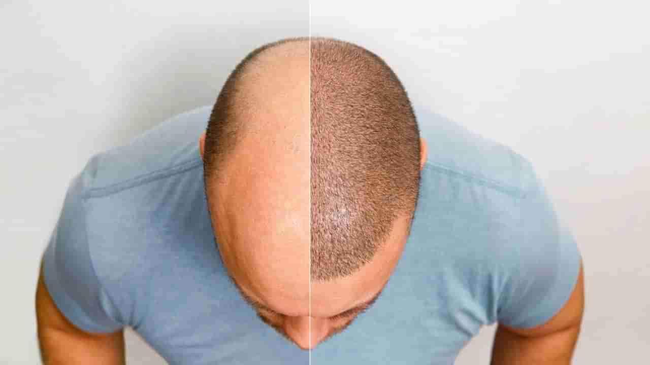 బట్టతలకు విరుగుడు కనిపెట్టామన్నారు.. లచ్చలు లచ్చలు పోశాడు.. ఆ తర్వాత సీన్ ఇదే!