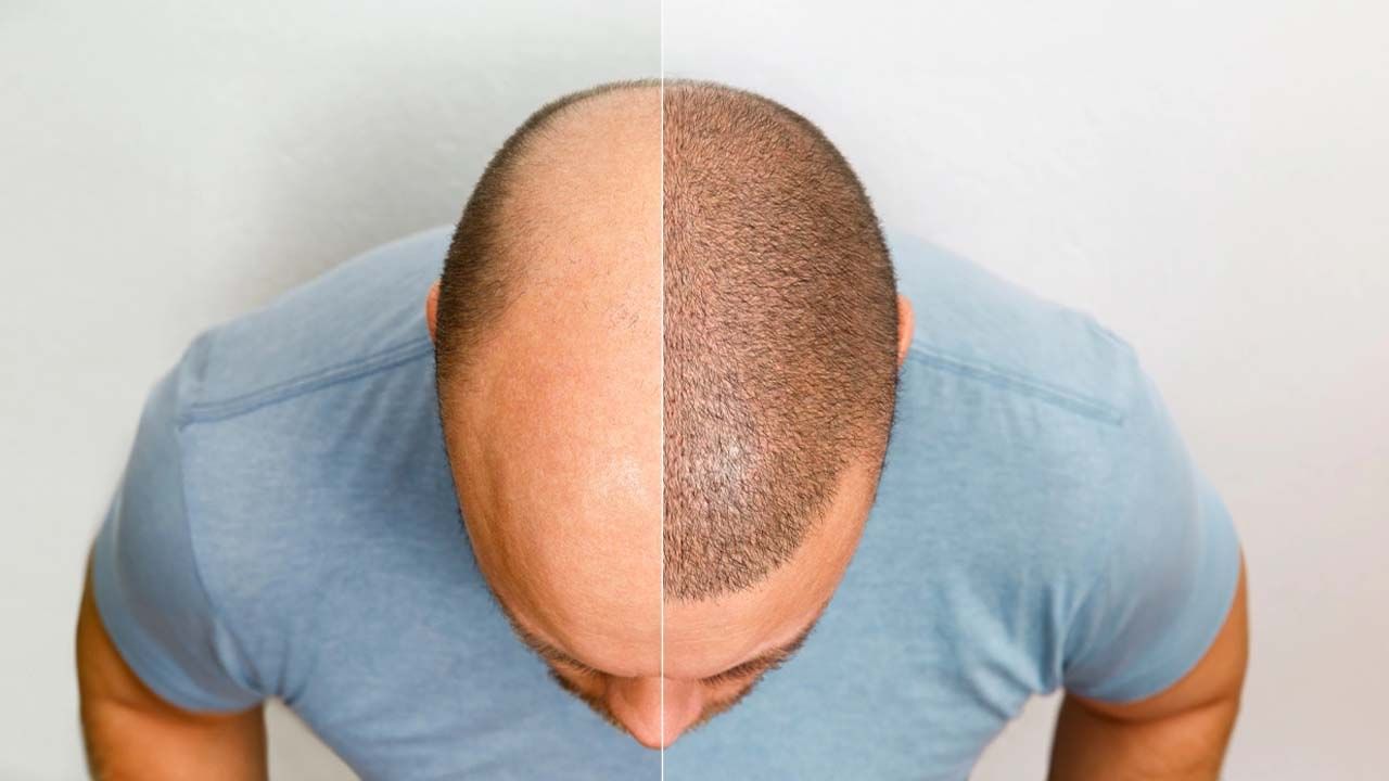 బట్టతలకు విరుగుడు కనిపెట్టామన్నారు.. లచ్చలు లచ్చలు పోశాడు.. ఆ తర్వాత సీన్ ఇదే!