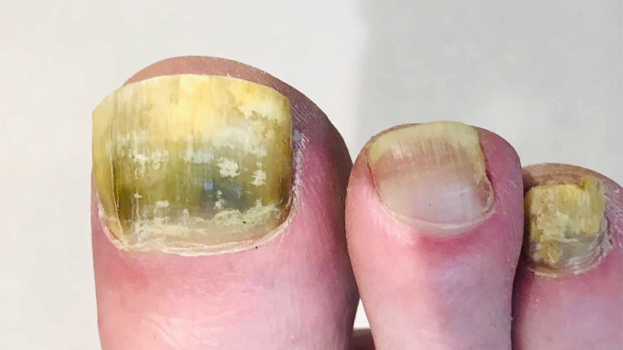 అందుకే మట్టి గోళ్ళలో చేరితే విస్మరించవద్దు. ఇది కూడా ఫంగల్ ఇన్ఫెక్షన్‌కు సంకేతం. అందుకే గోళ్లను జాగ్రత్తగా చూసుకోవాలి. పాదాలను జాగ్రత్తగా చూసుకోకపోతే, గోర్లు కుళ్ళిపోయే ప్రమాదం ఉంది. బయటి నుంచి ఇంటికి వచ్చిన ప్రతిసారీ పాదాలను కడుక్కుంటూ ఉండాలి. పాదాలను సబ్బుతో బాగా కడగడం ద్వారా, ఫంగల్ ఇన్ఫెక్షన్ ప్రమాదాన్ని సులభంగా నివారించవచ్చు.