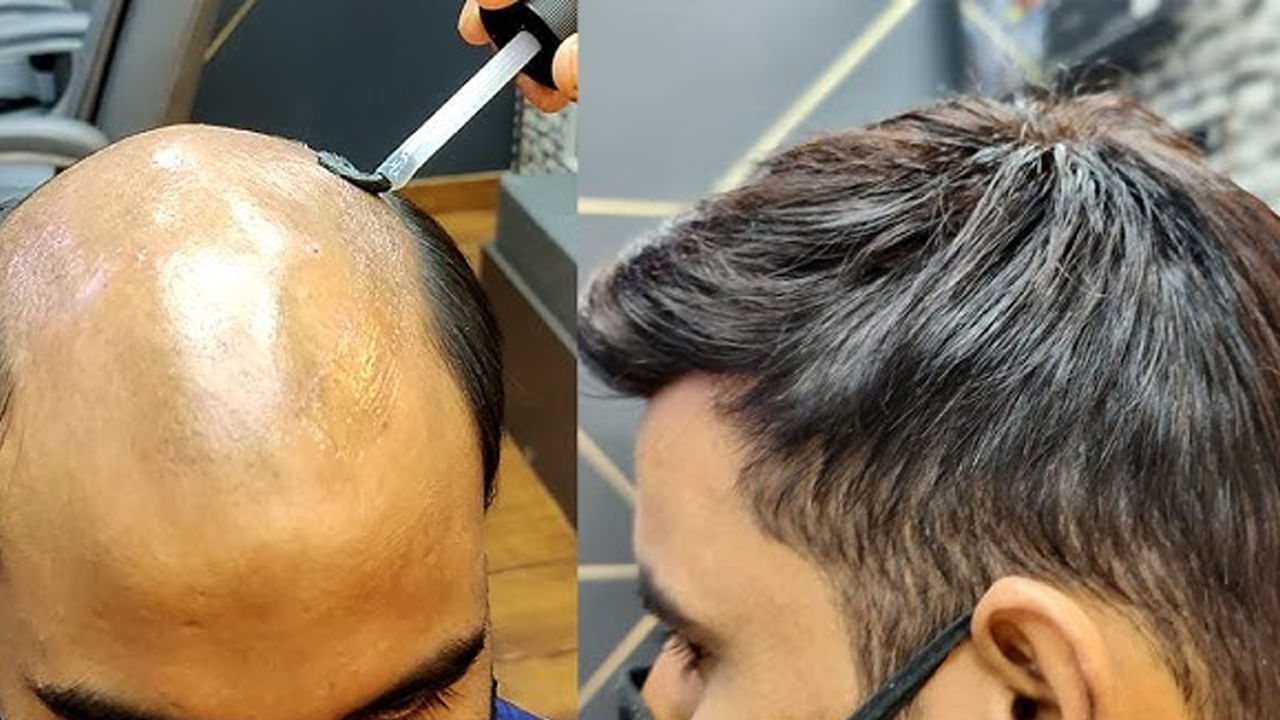 Hair loss remedies: విగ్, హెయిర్ ప్యాచ్, ట్రాన్స్ప్లాంట్.. మూడింటికి తేడా ఏంటి..? వేరే ఆప్షన్స్ ఉన్నాయా Hair loss remedies: విగ్, హెయిర్ ప్యాచ్, ట్రాన్స్ప్లాంట్.. మూడింటికి తేడా ఏంటి..? వేరే ఆప్షన్స్ ఉన్నాయా