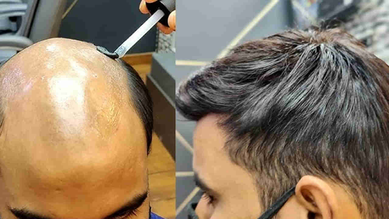 Hair loss remedies: విగ్, హెయిర్ ప్యాచ్, ట్రాన్స్ప్లాంట్.. మూడింటికి తేడా ఏంటి..? వేరే ఆప్షన్స్ ఉన్నాయా