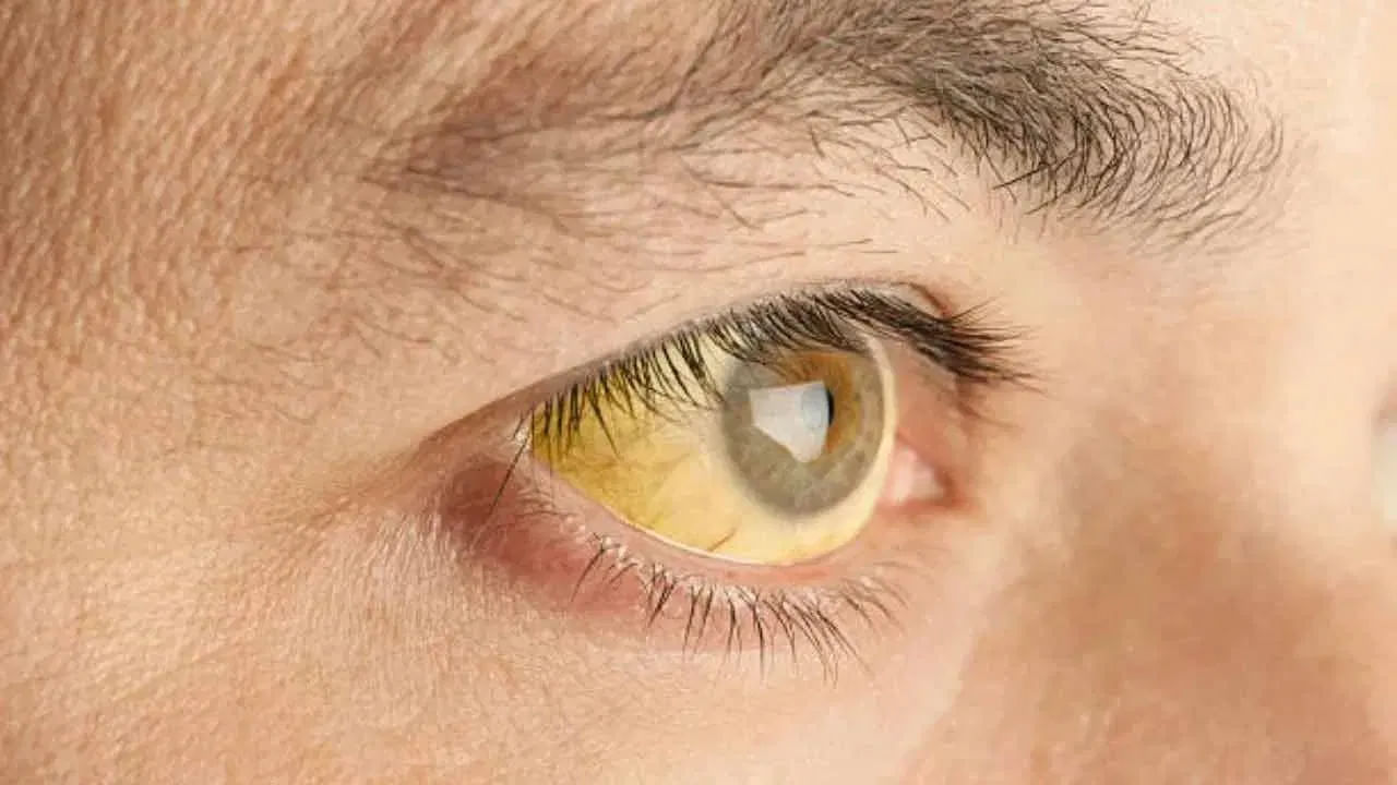 High Cholesterol Symptoms