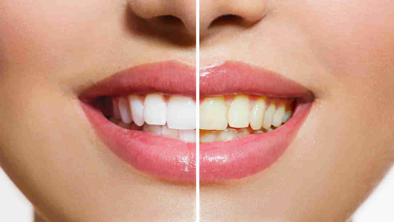 Health Tips: ఈ ఒక్క చిట్కాతో మీ పసుపు దంతాలకు చెప్పండి గుడ్బై.. ఇక మెరిసే దంతాలు మీ సొంతం!