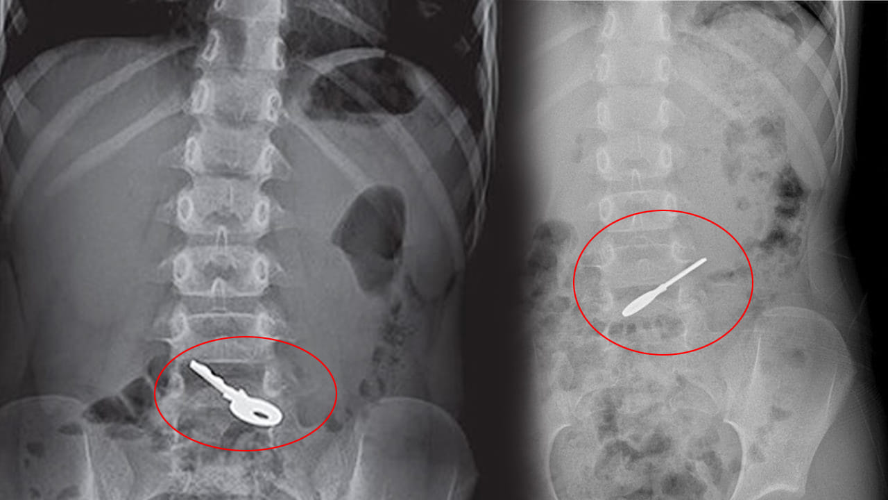 Viral: బిక్కుబిక్కుమంటూ ఇంటికి చేరిన బాలిక.. ఏది తిన్నా వికారం.. ఆస్పత్రికి తీసుకెళ్లగా