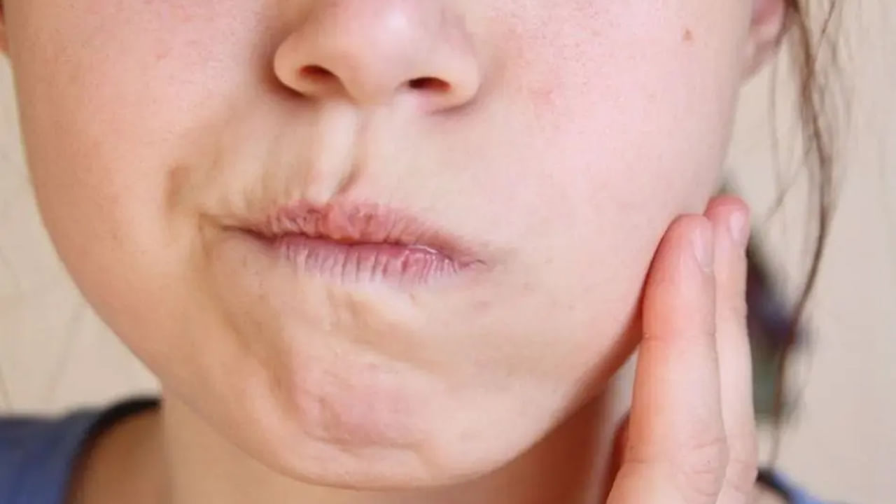 ముఖం అకస్మాత్తుగా వాపు: కొన్ని రోజుల్లో మీ ముఖం ఉబ్బినట్లు అనిపిస్తే లేదా ఎటువంటి కారణం లేకుండా బరువు పెరిగితే, అది శరీరంలో ద్రవం నిలుపుదల సంకేతం కావచ్చు. ఇది మూత్రపిండాల వైఫల్యానికి ప్రారంభ లక్షణం.