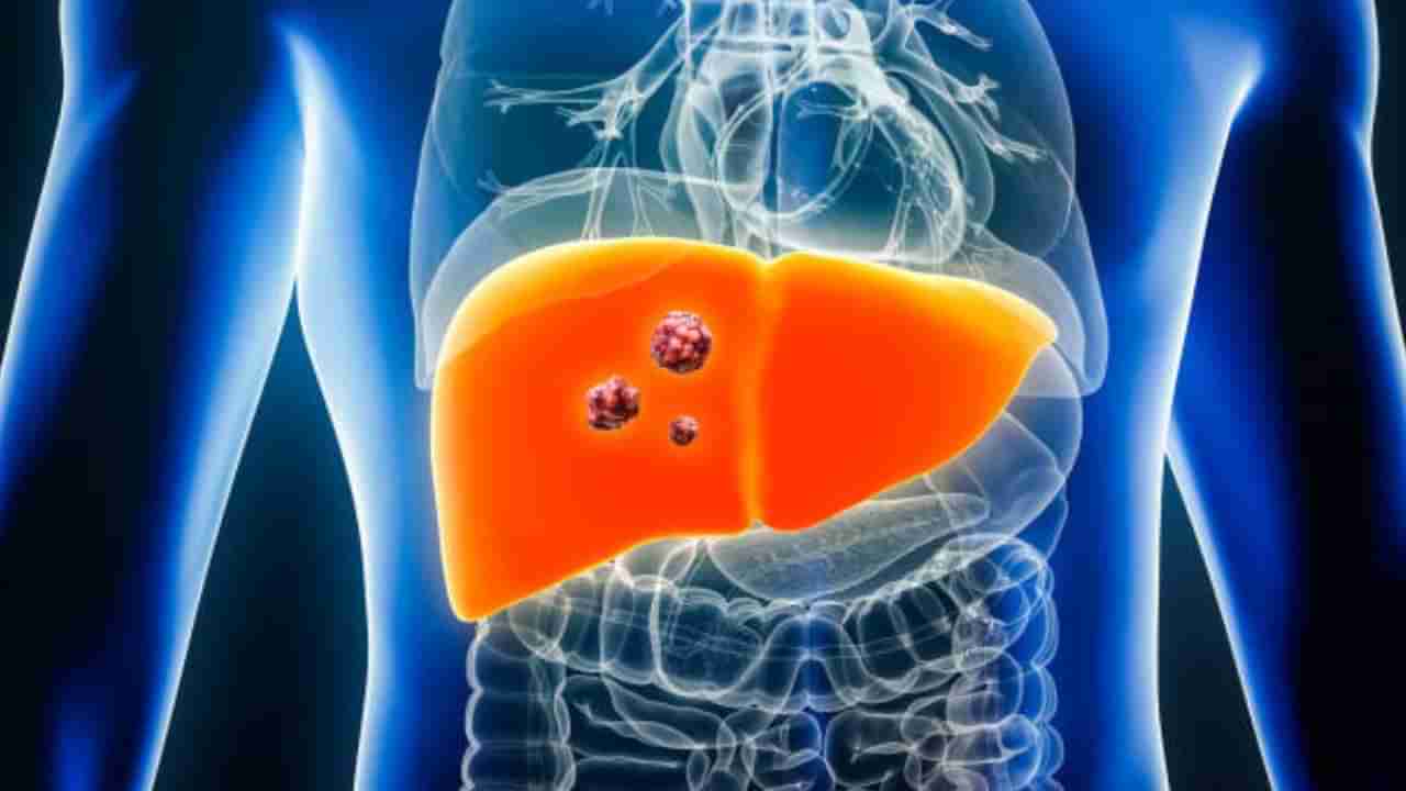 Liver Cancer: ఈ లక్షణాలు కనిపిస్తే అస్సలు నిర్లక్ష్యం చేయకండి..! తొలిదశలో కనిపించే ముఖ్యమైన లక్షణాలు ఇవే..!