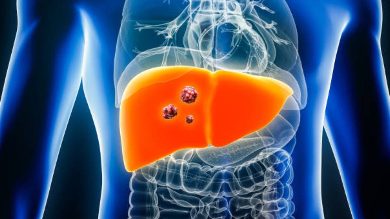 Liver Cancer: ఈ లక్షణాలు కనిపిస్తే అస్సలు నిర్లక్ష్యం చేయకండి..! తొలిదశలో కనిపించే ముఖ్యమైన లక్షణాలు ఇవే..!