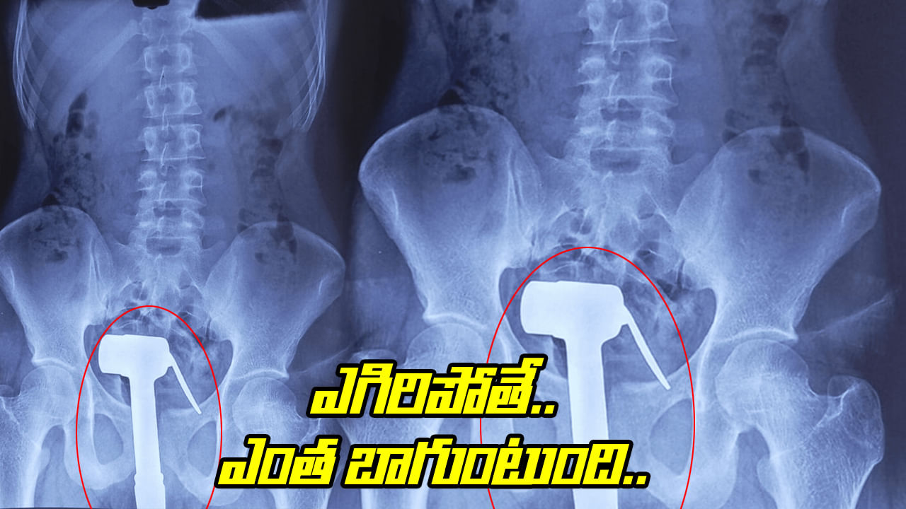 Viral: ఎగిరిపోతే ఎంత బాగుంటుంది.! ప్రైవేట్ పార్టులో నొప్పితో ఆస్పత్రికి.. టెస్టులు చేయగా Viral: ఎగిరిపోతే ఎంత బాగుంటుంది.! ప్రైవేట్ పార్టులో నొప్పితో ఆస్పత్రికి.. టెస్టులు చేయగా