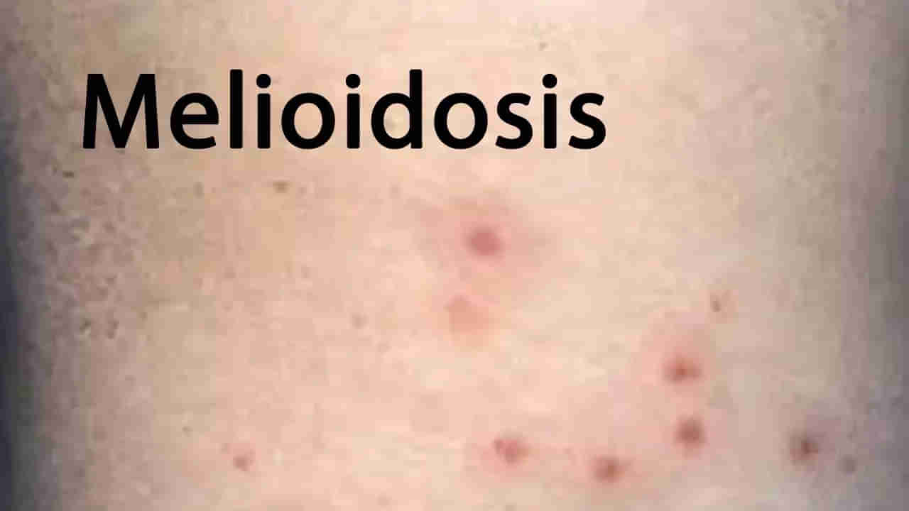 Guntur: విజృంభిస్తున్న కొత్త బ్యాక్టిరీయా.... బీ అలెర్ట్ అంటున్న వైద్యులు