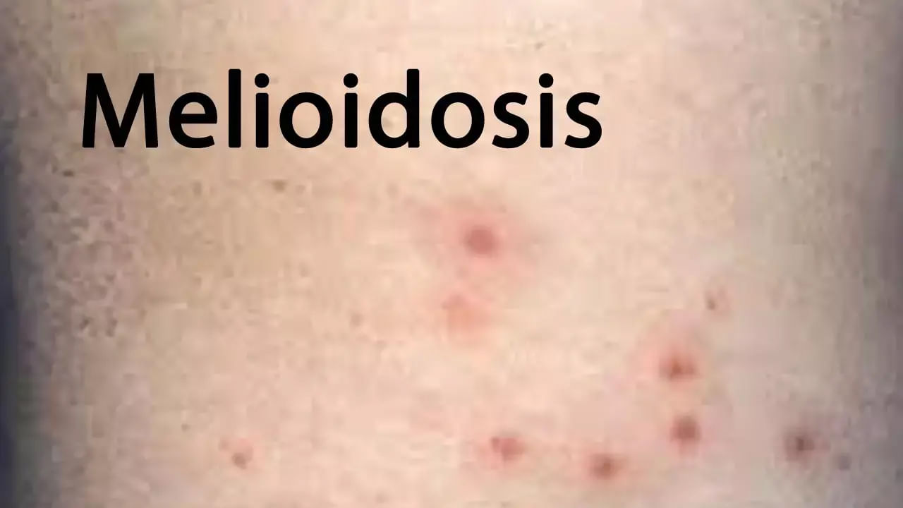 Guntur: విజృంభిస్తున్న కొత్త బ్యాక్టిరీయా.... బీ అలెర్ట్ అంటున్న వైద్యులు