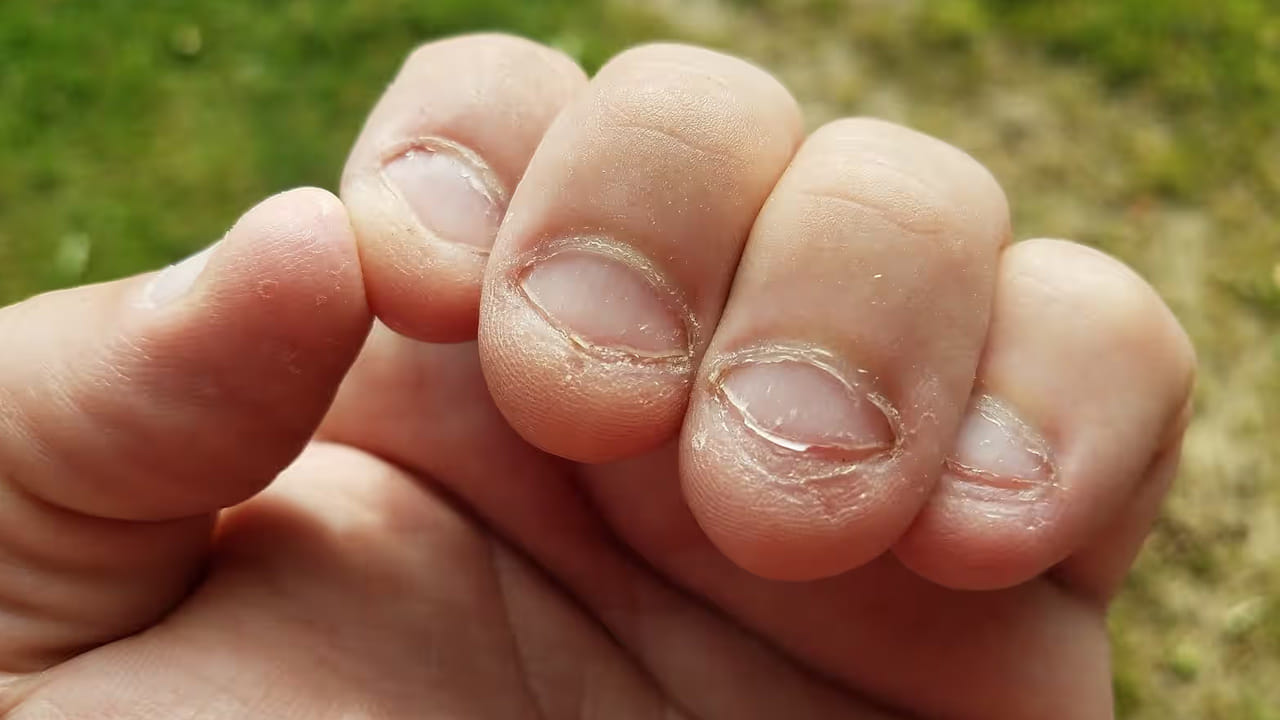 గోళ్ళు కొరకడం వలన సూర్య దోషం మాత్రమే కాదు శని దోషం రావచ్చు. గోర్లు కొరకడం శని దోషం లక్షణం కావచ్చు. అంటే శనీశ్వర చెడు దృష్టి మీపై ఉందని అర్థం. వీలైనంత త్వరగా ఈ అలవాటును వదులుకోవాలని పండితులు సూచిస్తున్నారు.