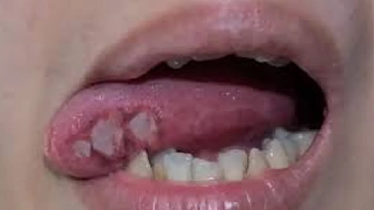 నోటి క్యాన్సర్: పొగాకు, పాన్-మసాలా, చెడు ఆహారపు అలవాట్ల వల్ల దేశంలో నోటి క్యాన్సర్ కేసులు నిరంతరం పెరుగుతున్నాయి. అందుకే దేశాన్ని 'ఓరల్ క్యాన్సర్కు రాజధాని' అని కూడా పిలుస్తున్నారు. ఈ వ్యాధిని అరికట్టడానికి ముందస్తుగా గుర్తించడం, నివారణ చర్యలు తీసుకోవడం, తక్కువ ధరకే దంత బీమా సౌకర్యాలు అందుబాటులోకి తీసుకురావడం చాలా ముఖ్యం అని నిపుణులు సూచిస్తున్నారు.