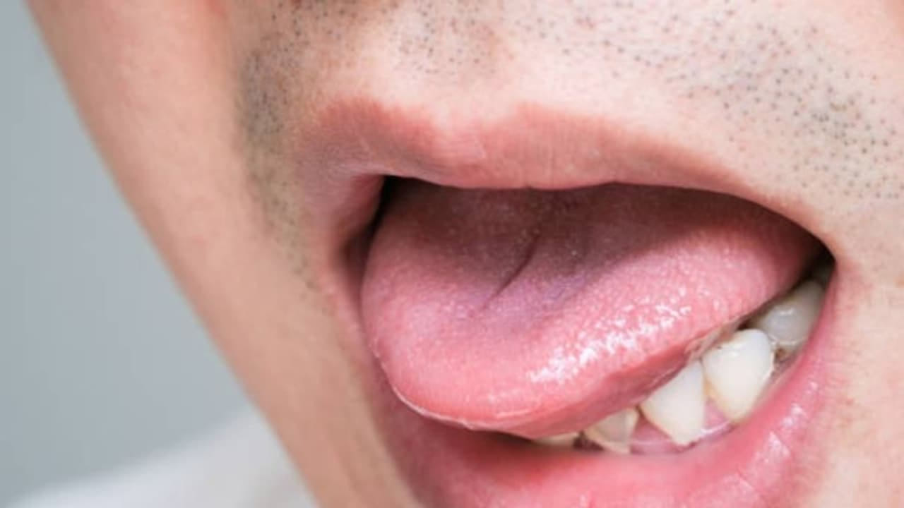 మీ నాలుక తిమ్మిరిగా, జలదరించినట్టు అనిపిస్తే మీరు జాగ్రత్తగా ఉండాల్సి అవసం ఎంతగానో ఉంది. ఎందుకంటే ఈ లక్షణాలు మన నాడీ సంబంధిత వ్యాధులకు సంకేతం కావచ్చు. విటమిన్ బి12 లోపం లేదా మధుమేహాన్ని సూచించవచ్చు.మీలో ఈ లక్షణం పదే పదే కనిపిస్తే వెంటనే వైద్యుణ్ని సంప్రదించి తగిన పరీక్షలు చేయించుకోండి. ( గమనిక: ఈ అంశాలు ఆరోగ్య నిపుణులు, నివేదికలు, ఇంటర్నెట్‌ నుంచి సేకరించిన వివారాల ఆధారంగా అదించబడ్డాయి. వీటిలో మీకు ఏవైనా సందేహాలు ఉంటే వెంటనే వైద్యుడిని సంప్రదించండి)