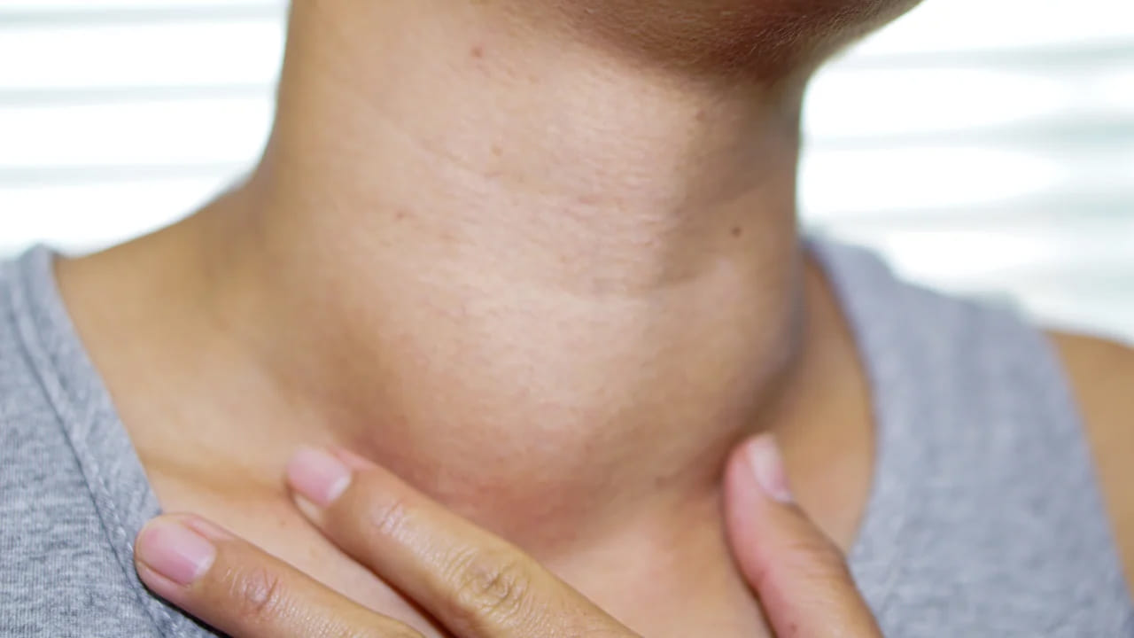 శరీరంలో థైరాయిడ్ హార్మోన్ల సమతుల్యతను కాపాడుకోవడానికి, రోగనిరోధక శక్తిని పెంచడానికి మందులు అవసరం. అయితే కేవలం మందులు మాత్రం తీసుకుంటే సరిపోదు. కొన్ని ఆహార జాగ్రత్తలు తప్పక తీసుకోవాలి. థైరాయిడ్ సమస్య ఉన్న రోగులు అస్సలు తినకూడని 5 ఆహారాలు ఇవే. వీటిని తింటే తీసుకునే మందుల ప్రభావాన్ని కూడా పాడు చేస్తాయి. థైరాయిడ్ వ్యాధిగ్రస్తులు సోయా ఆహారాలకు దూరంగా ఉండాలని అనేక అధ్యయనాలు సూచిస్తున్నాయి. ఇది థైరాయిడ్ మందులు సరిగా పనిచేయకపోవడానికి కారణమవుతుంది.