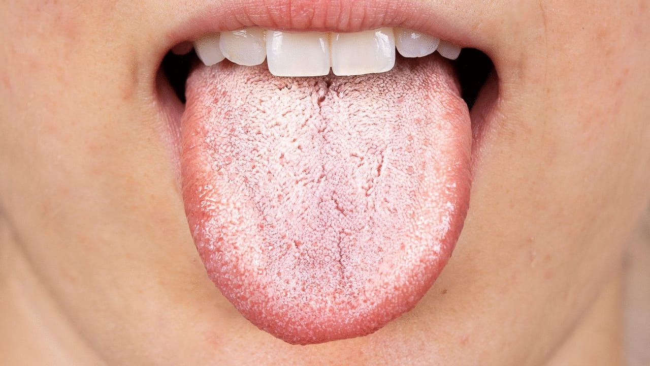 మీ నాలుకపై తెల్లటి, బూజు పట్టిన పూత కనిపిస్తే, మీరు జాగ్రత్తగా ఉండాలి. ఇది అనారోగ్యానికి సంకేతం. రోగనిరోధక శక్తి తక్కువగా ఉన్నవారిలో, చిన్న పిల్లలలో ఇది సాధారణంగా కనిపిస్తుంది. ఇది అజీర్ణ సమస్య వల్ల కూడా సంభవించవచ్చు. కొన్నిసార్లు, యాంటీబయాటిక్స్ తీసుకున్న తర్వాత కూడా మీ నాలుకపై తెల్లటి పూత కనిపించవచ్చు. 