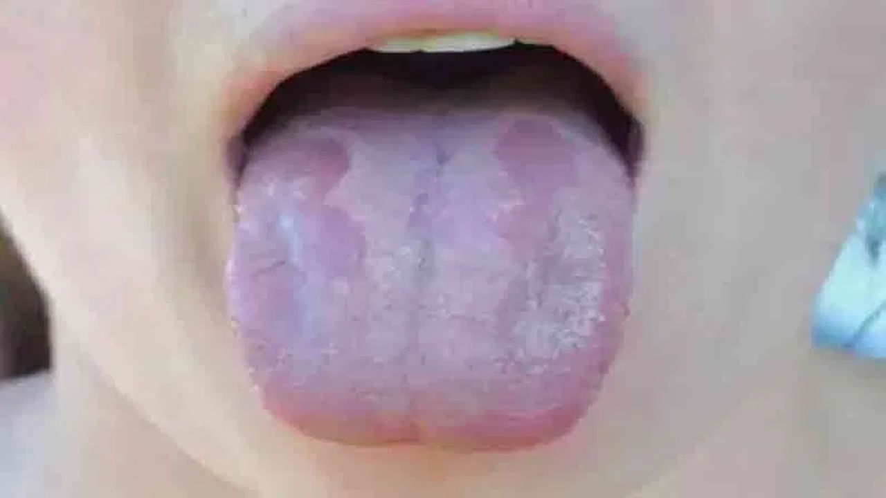 మీ నాలుకపై చిన్న బొబ్బలు, లేదా తెల్ల మచ్చలు వంటికి కనిపిస్తే, మీరు కచ్చితంగా ఆందోళన చెందాల్సి ఉంటుంది. ఎందుకంటే ఇవి మీ అనారోగ్యాన్ని సూచించవచ్చు. బ్యాక్టీరియా, ఈస్ట్ లేదా వైరస్‌ల వల్ల కలిగే ఇన్ఫెక్షన్లు కారణంగా మన నాలుకపై ఈ బొబ్బల్లు వస్తాయి.  TSH, ఉచిత T3, రివర్స్ T3, లింఫ్ మార్కర్స్ వంటి కొన్ని పరీక్షలు ఖచ్చితమైన వ్యాధిని గుర్తించడంలో మనకు సహాయపడతాయి. 
