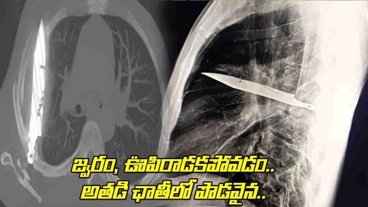 Viral: వ్యక్తికి తీవ్రమైన జ్వరం, ఊపిరాడకపోవడం.. CT స్కాన్ చేయగా.. అతడికి ఛాతిలో పొడవైన