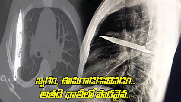 Viral: వ్యక్తికి తీవ్రమైన జ్వరం, ఊపిరాడకపోవడం.. CT స్కాన్ చేయగా.. అతడికి ఛాతిలో పొడవైన