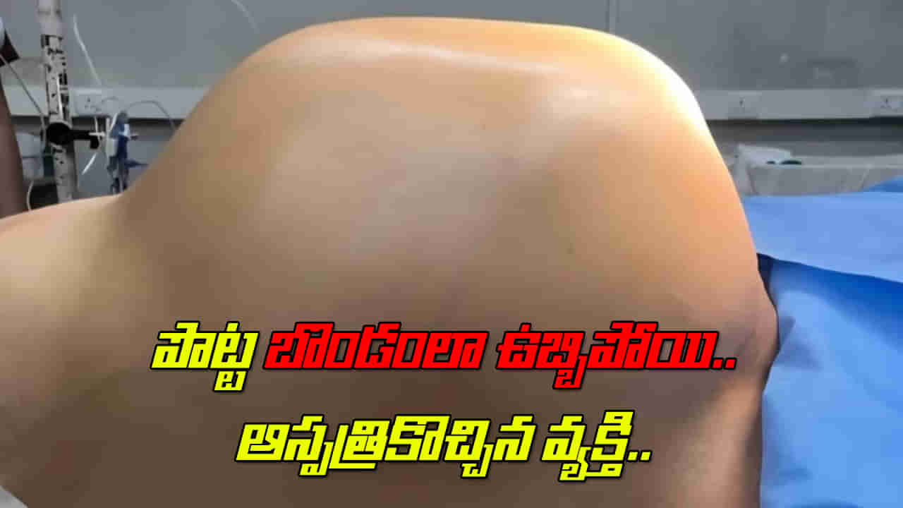 Viral: పొట్ట బొండంలా ఉబ్బిపోయి ఆస్పత్రికొచ్చిన వ్యక్తి.. టెస్టులు చేయగా.. అతడి కడుపులో బరువైన