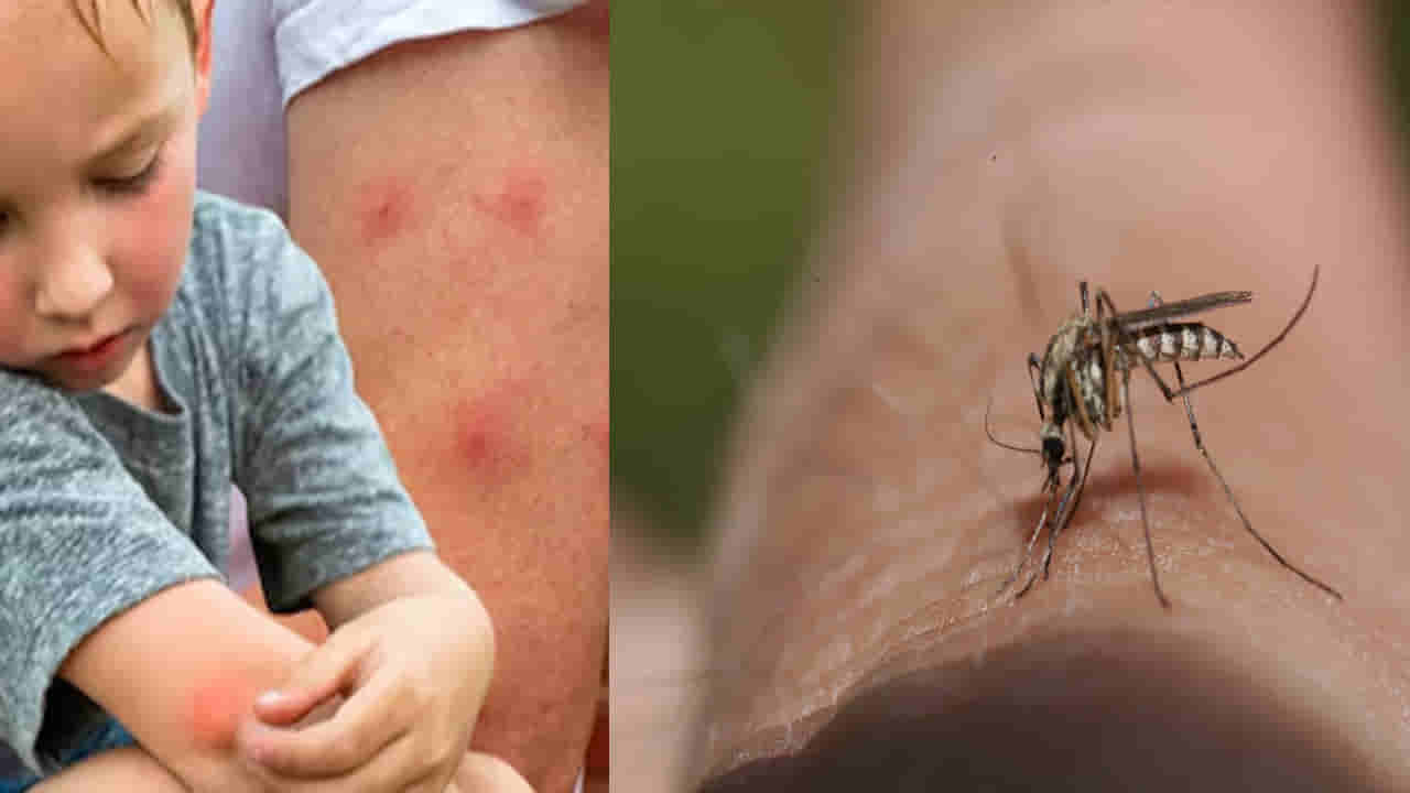 World Mosquito Day 2025: ఐస్ నుంచి కలబంద వరకు... దోమలు కుట్టినప్పుడు ఈ 7 ఇంటి చిట్కాలను ట్రై చేయండి..