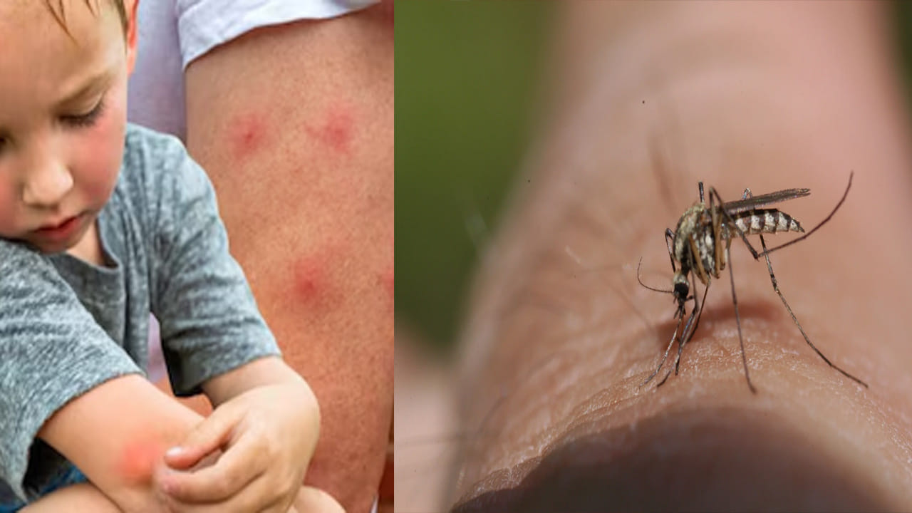 World Mosquito Day 2025: ఐస్ నుంచి కలబంద వరకు... దోమలు కుట్టినప్పుడు ఈ 7 ఇంటి చిట్కాలను ట్రై చేయండి..