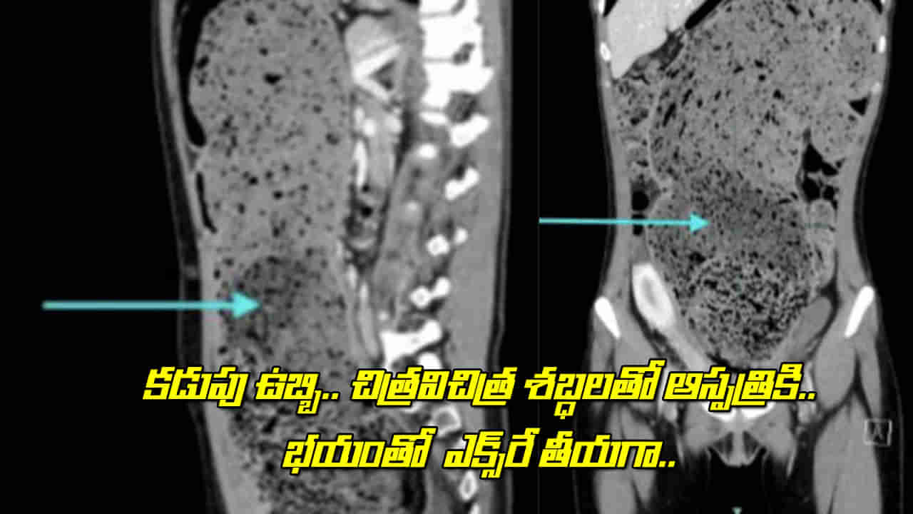 Viral: కడుపు ఉబ్బి.. చిత్రవిచిత్ర శబ్దాలతో ఆస్పత్రికి.. భయంతో ఎక్స్‌రే తీయగా.. అందులో పొడవైన