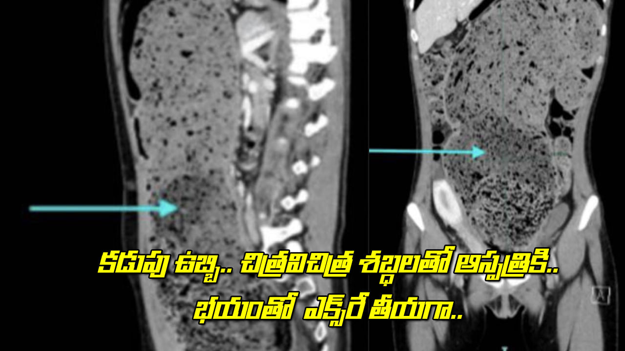 Viral: కడుపు ఉబ్బి.. చిత్రవిచిత్ర శబ్దాలతో ఆస్పత్రికి.. భయంతో ఎక్స్‌రే తీయగా.. అందులో పొడవైన