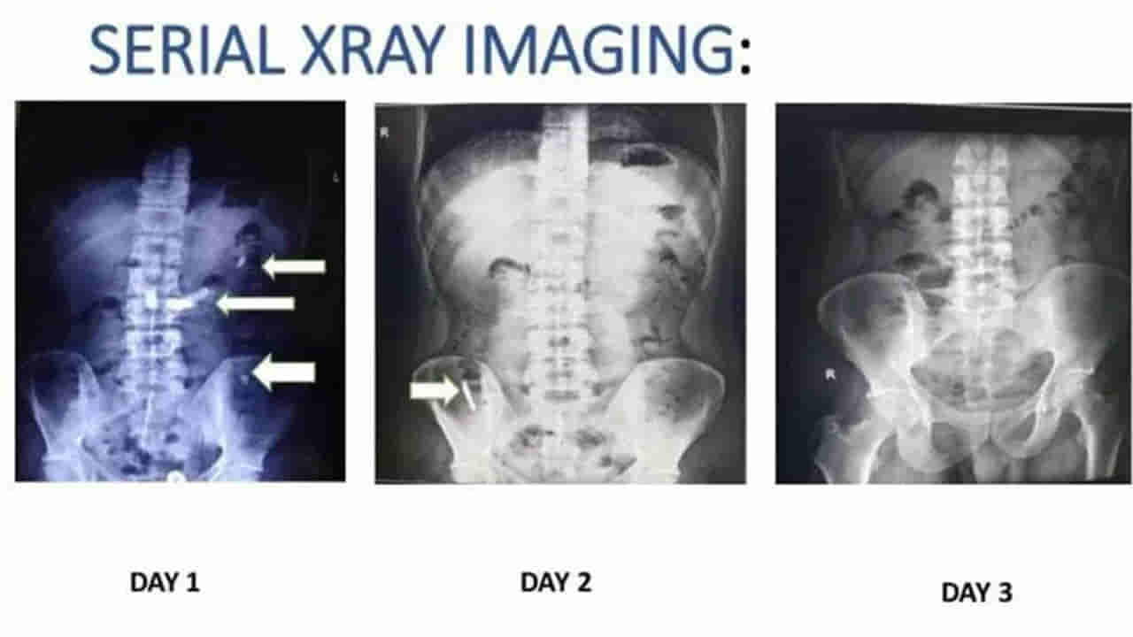Gandhi Hospital: బ్లేడ్ మింగిన వ్యక్తి. 48 గంటల తర్వాత ఆస్పత్రికి.. డాక్టర్లు ఏం చేశారంటే..?