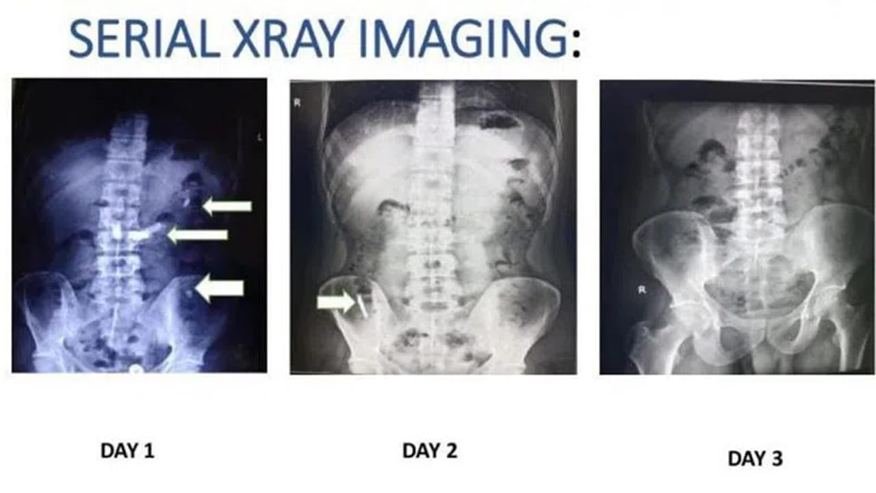 Gandhi Hospital: బ్లేడ్ మింగిన వ్యక్తి. 48 గంటల తర్వాత ఆస్పత్రికి.. డాక్టర్లు ఏం చేశారంటే..?