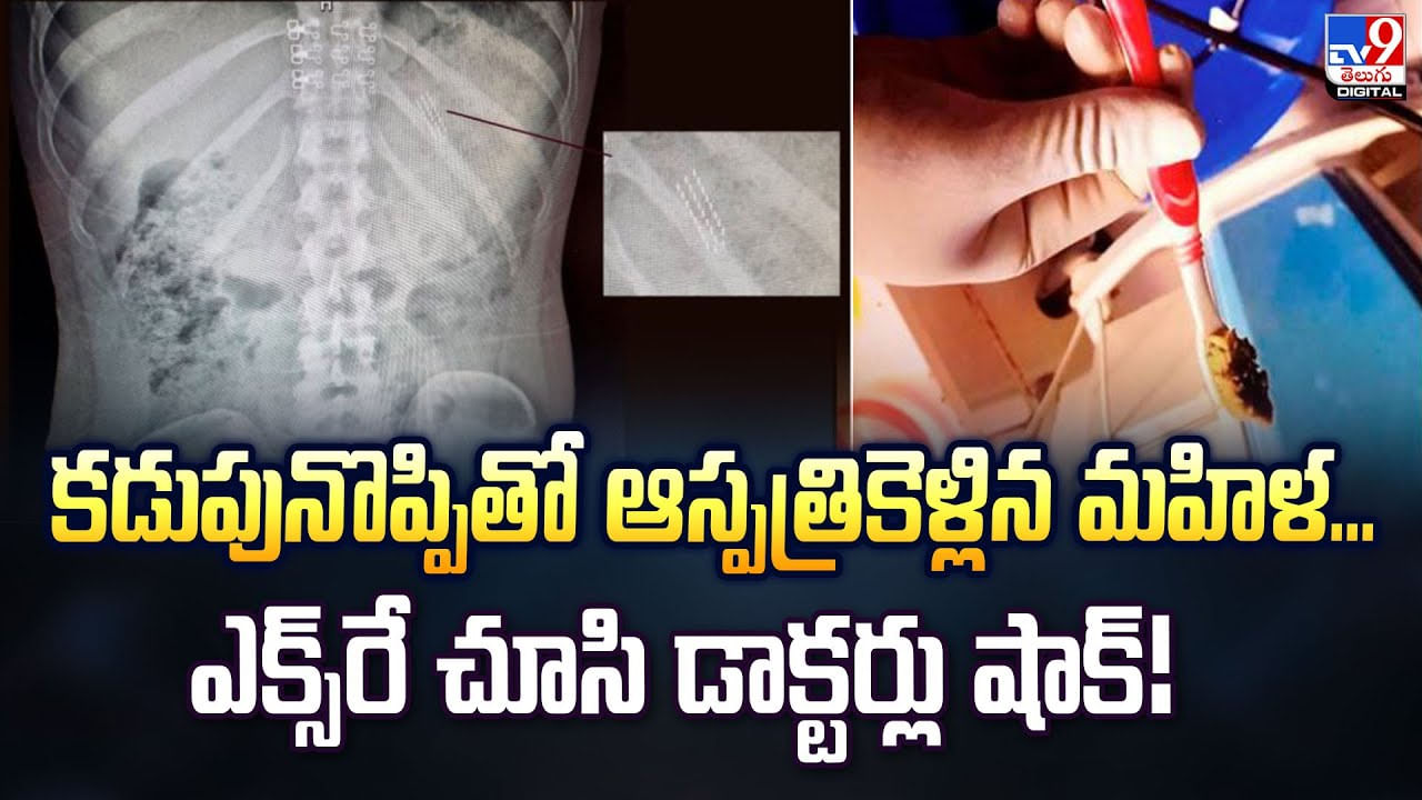 బొజ్జ నొప్పితో బోరుమంటూ ఏడుస్తూ ఆస్పత్రికెళ్లిన మహిళ.. ఎక్స్‌రే చూసి డాక్టర్లు షాక్‌