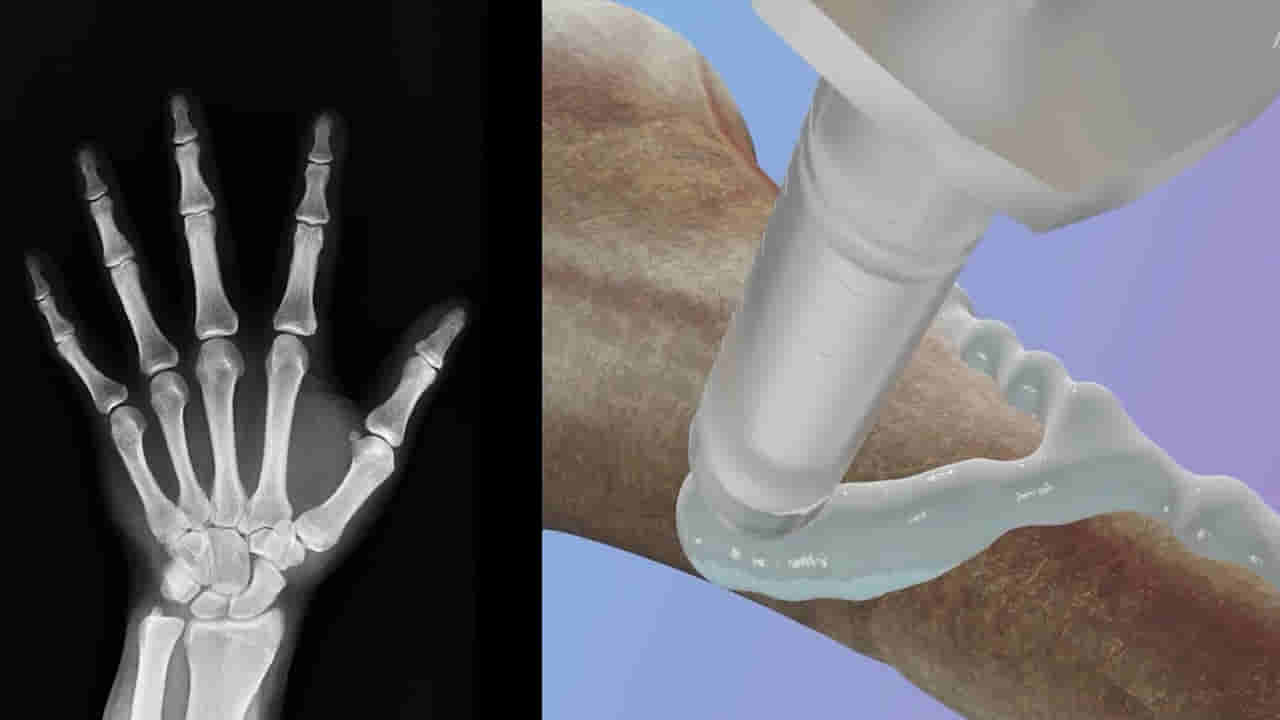 మూడే.. 3 నిమిషాలు.. విరిగిన ఎముకలను ఇట్టే జాయింట్ చేస్తుంది.. సరికొత్త ‘బోన్ గ్లూ’ కనుగొన్న సైంటిస్టులు..