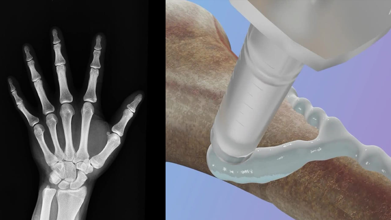 మూడే.. 3 నిమిషాలు.. విరిగిన ఎముకలను ఇట్టే జాయింట్ చేస్తుంది.. సరికొత్త ‘బోన్ గ్లూ’ కనుగొన్న సైంటిస్టులు..