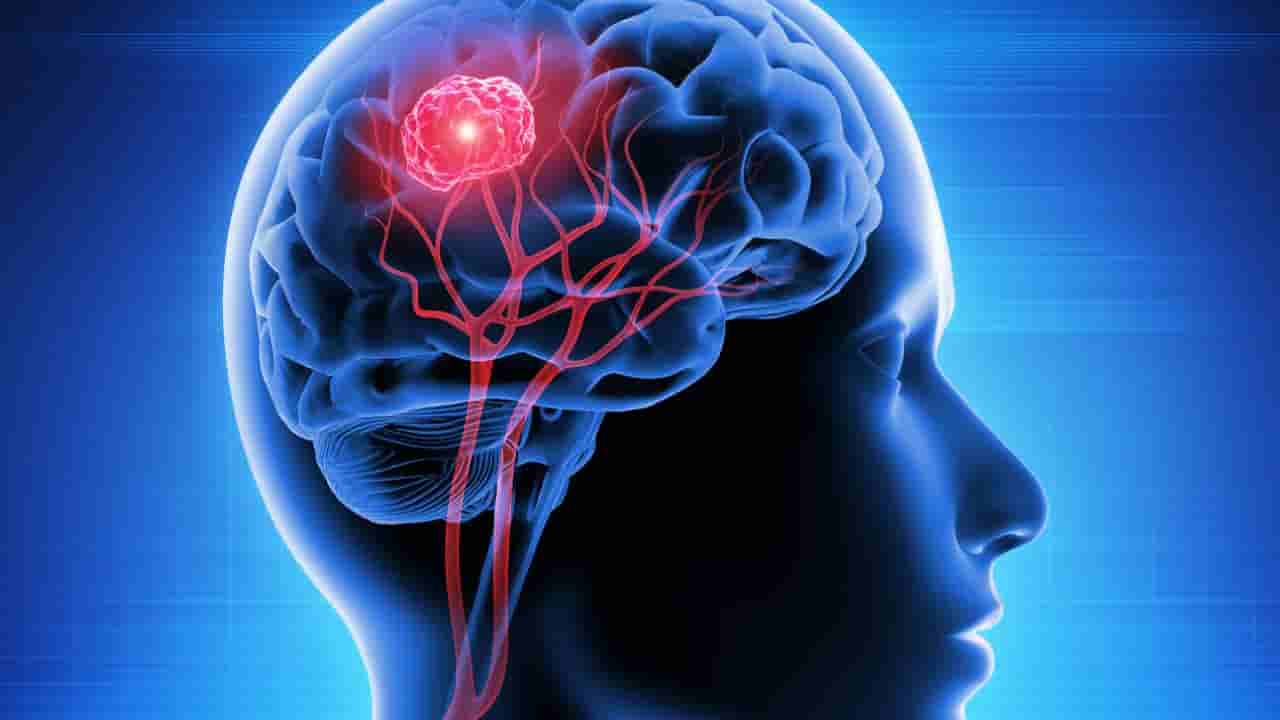 యువతలో బ్రెయిన్ ట్యూమర్.. ఏ వయసు వారికి ఎక్కువ ప్రమాదం అంటే..?