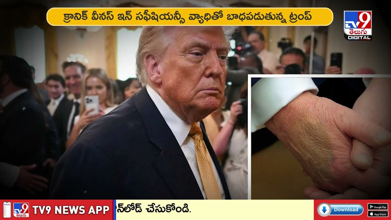 Video: కాలు తీసేయాల్సి రావొచ్చు..ట్రంప్ హెల్త్‌పై డాక్టర్ సంచలనం