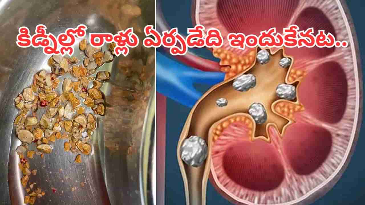 ఓర్నీ.. ఇంత పే..ద్ద.. కథ ఉందా.. కిడ్నీల్లో రాళ్లు ఏర్పడటానికి కారణం ఇదేనట..