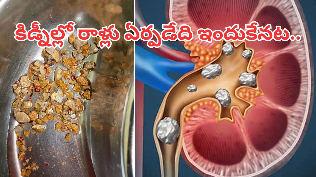 ఓర్నీ.. ఇంత పే..ద్ద.. కథ ఉందా.. కిడ్నీల్లో రాళ్లు ఏర్పడటానికి కారణం ఇదేనట..